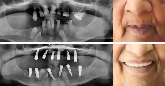 Full Mouth Dental Implants | All on 6