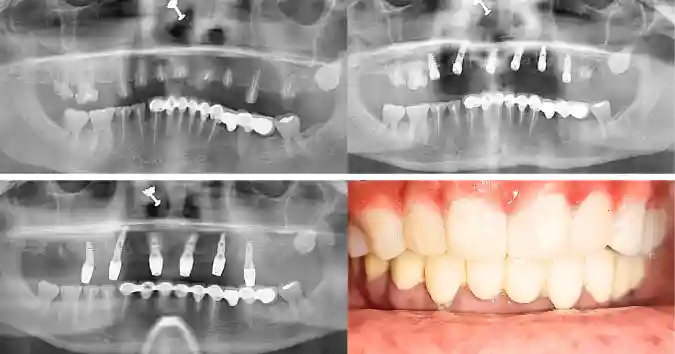 Half Arch Dental Implants 