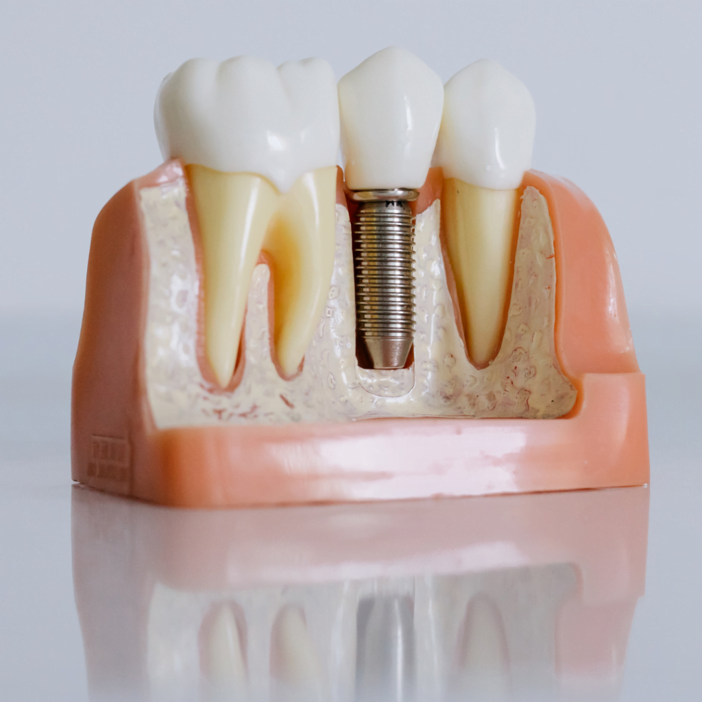 best dental implants in hyderabad