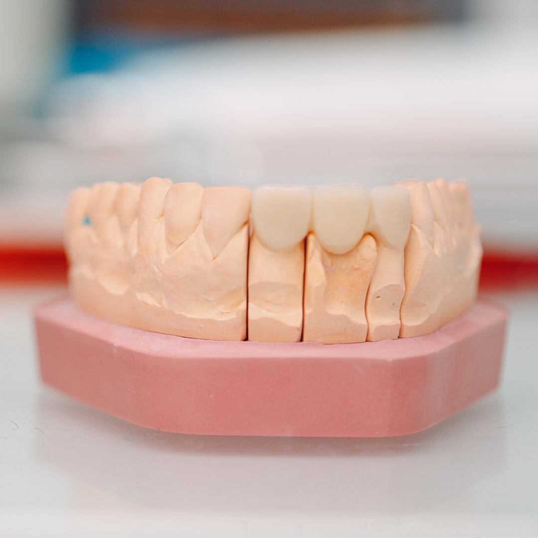 Crowns and Bridges 10 Dental Crowns and Bridges in Hyderabad