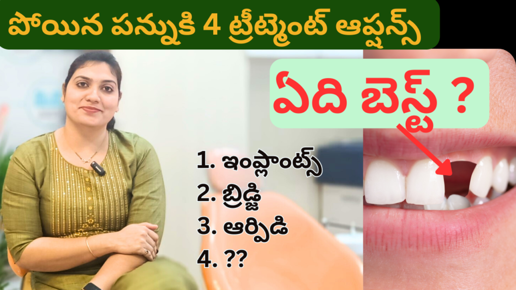 4 Best Tooth Replacement Options in Telugu | Replace Missing Tooth | పోయిన పన్నుకి ట్రీట్మెంట్ |