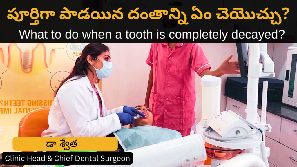 What to do when a tooth is completely decayed? in Telugu by Dr Swetha