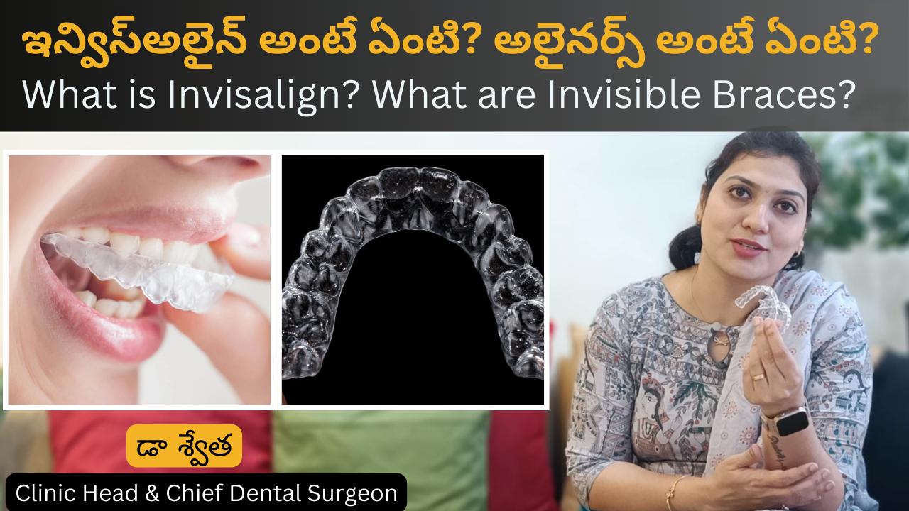 ఇన్విస్అలైన్ అంటే ఏంటి? What is Invisalign or Invisible Braces? in Telugu by Dr Swetha