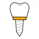 Immediate Dental Implant Placement After Tooth Extraction: A Comprehensive Guide 2 Best Immediate Dental Implant Placement after Tooth Extraction