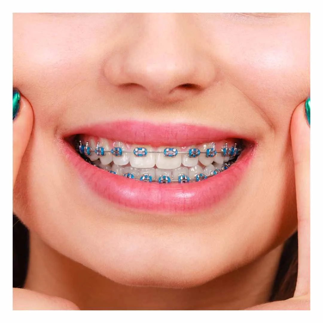 braces treatment