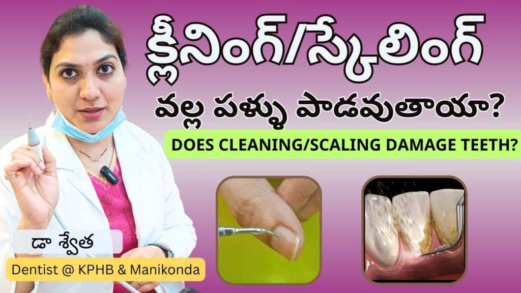 Best Dental Scaling or Teeth Scaling in Hyderabad | Platina Dental