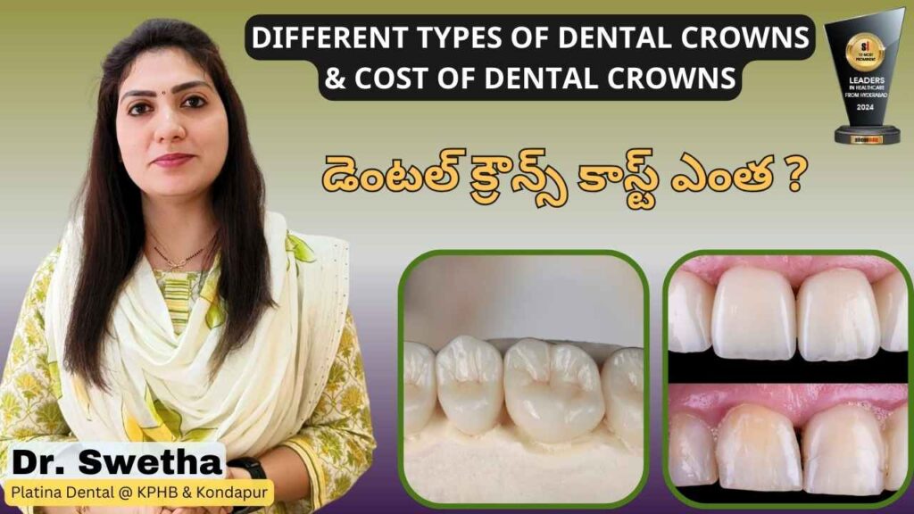 Types of Dental Crowns and Cost | Platina Dental