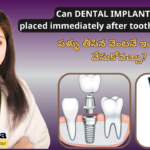 Best Dental Clinic near me for Immediate Dental Implant Placement After Tooth Extraction