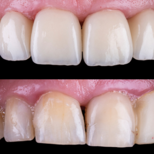 affordable emax crowns | platina dental | best dental clinic in hyderabad