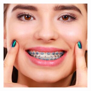 metal teeth braces at platina dental