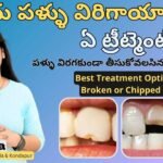 front broken teeth treatment