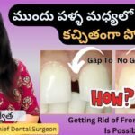 teeth gap filling, front teeth gap