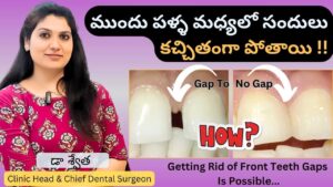 teeth gap filling, front teeth gap