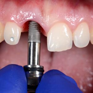 dental implant real1