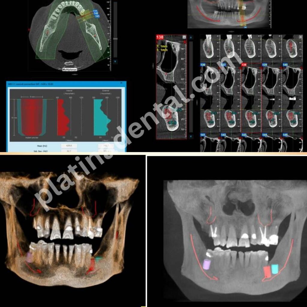 Digital-3d-CBCT-Implant-planning-in-hyderabad