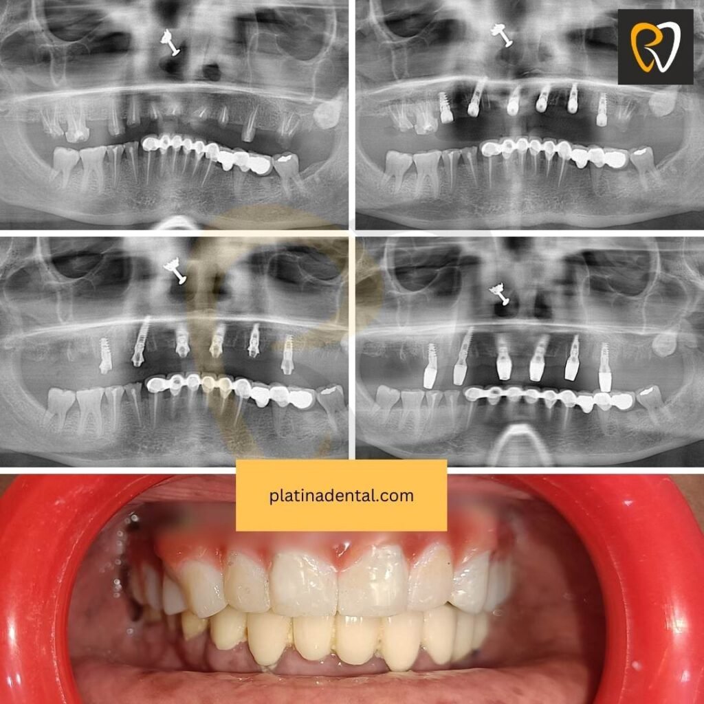 Before After 3 Dental implants before and after – immediate implant case