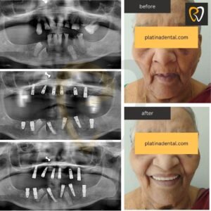 Tooth Replacement & Smile Restoration in Hyderabad 8 implants before after 2