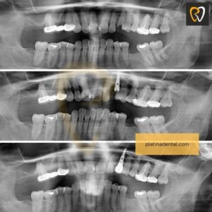 Tooth Replacement & Smile Restoration in Hyderabad 11 implants before after 3