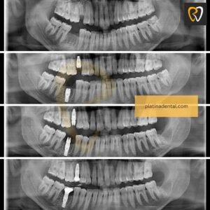 Tooth Replacement & Smile Restoration in Hyderabad 13 implants before after 4