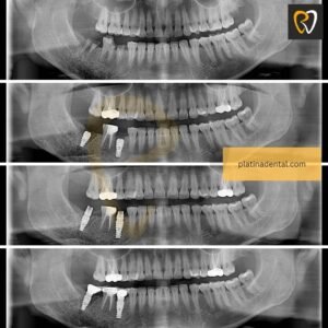 Tooth Replacement & Smile Restoration in Hyderabad 10 implants before after 7