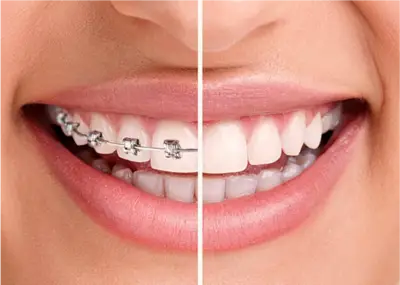 aligner braces