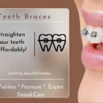 braces about