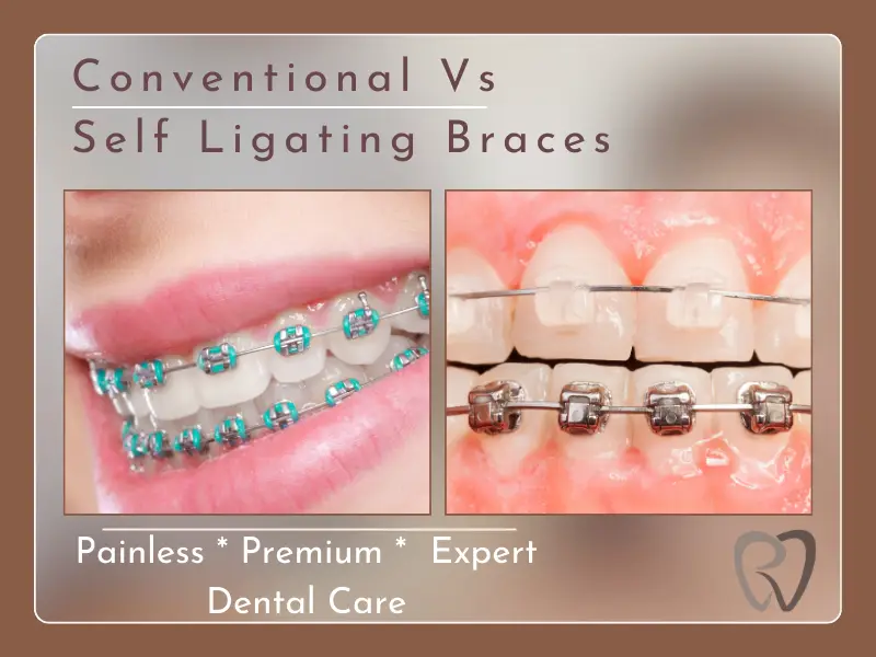 braces conventional selfligating