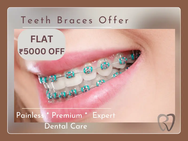 braces offer
