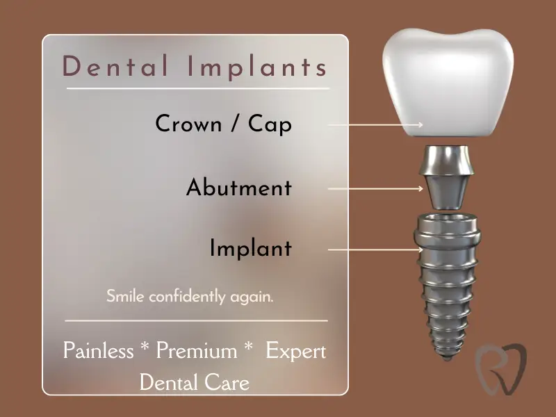 implants what