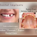 implants when