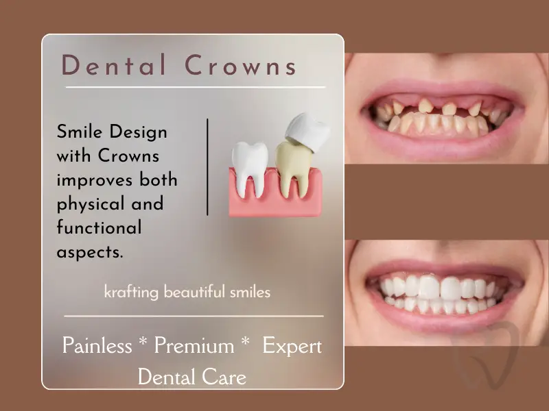 smile design crowns