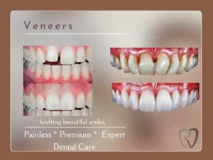 smile design veneers