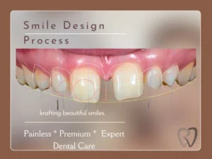 smile design what