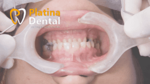 Comprehensive Full Mouth Rehabilitation with Basal Implants at Platina Dental