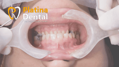 Comprehensive Full Mouth Rehabilitation with Basal Implants at Platina Dental