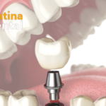 Dental Bridges: Types & Who Needs Them