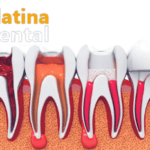 Painless Root Canal Treatments at Platina Dental Clinic: Redefining Endodontic Excellence