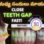 teeth gap yt tb