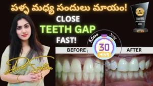 teeth gap yt tb