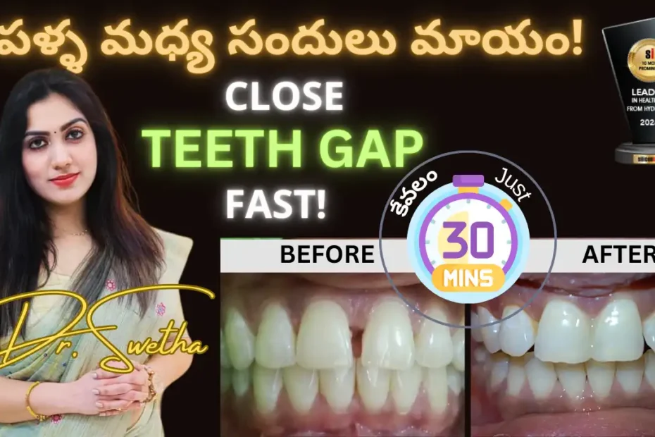 teeth gap yt tb