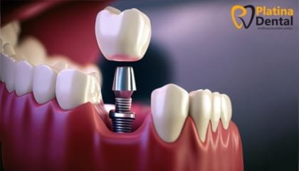 Dental Implants Hyderabad