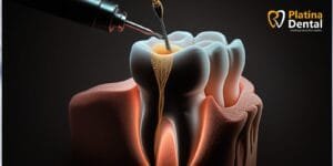 Root Canal Treatment in Hyderabad