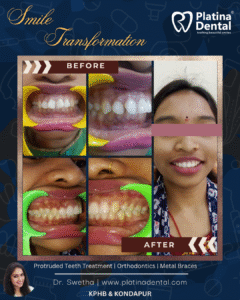 I have gaps in my teeth and my front teeth stick out… Can braces really fix this?
