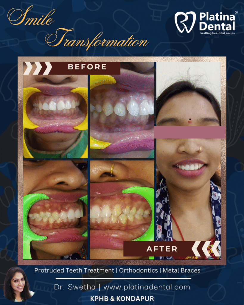 I have gaps in my teeth and my front teeth stick out… Can braces really fix this?