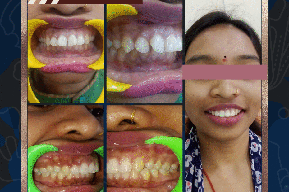 I have gaps in my teeth and my front teeth stick out… Can braces really fix this?