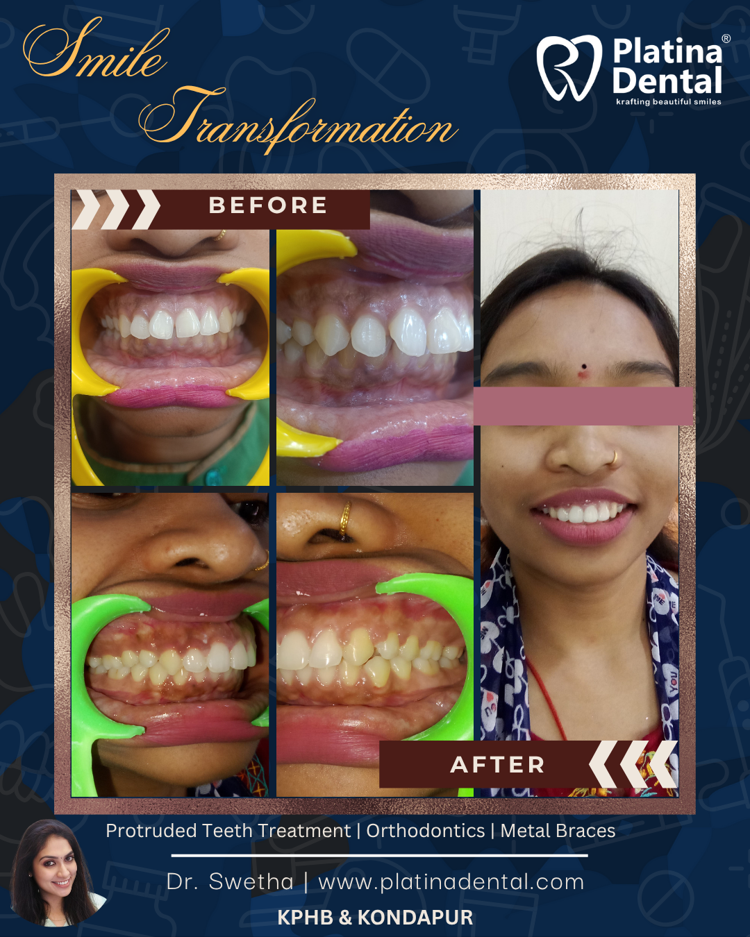 I have gaps in my teeth and my front teeth stick out… Can braces really fix this?