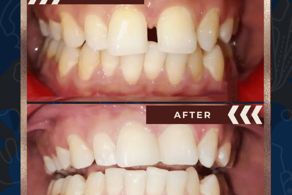 I have gap between my front teeth hyderabad