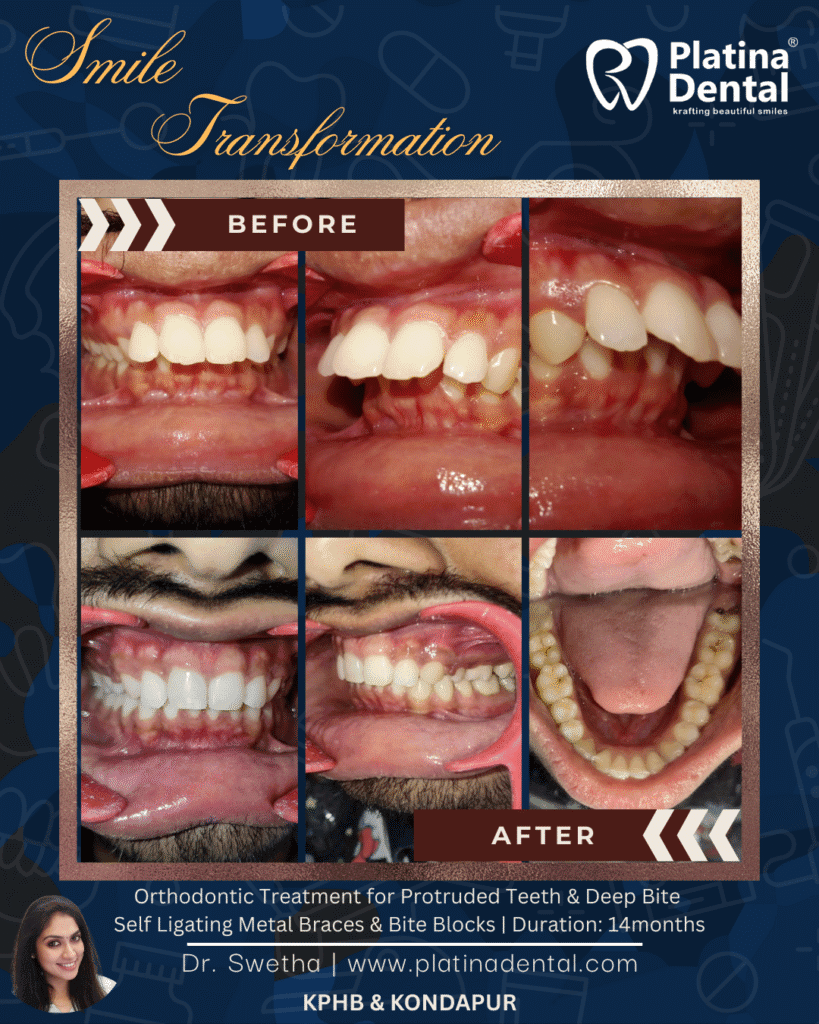 self-ligating metal braces in hyderabad