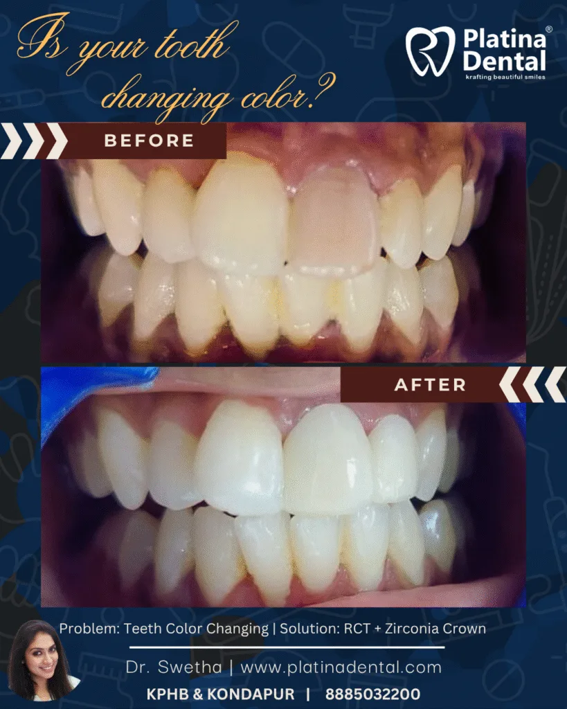 Discolored Front Tooth Treatment in Hyderabad