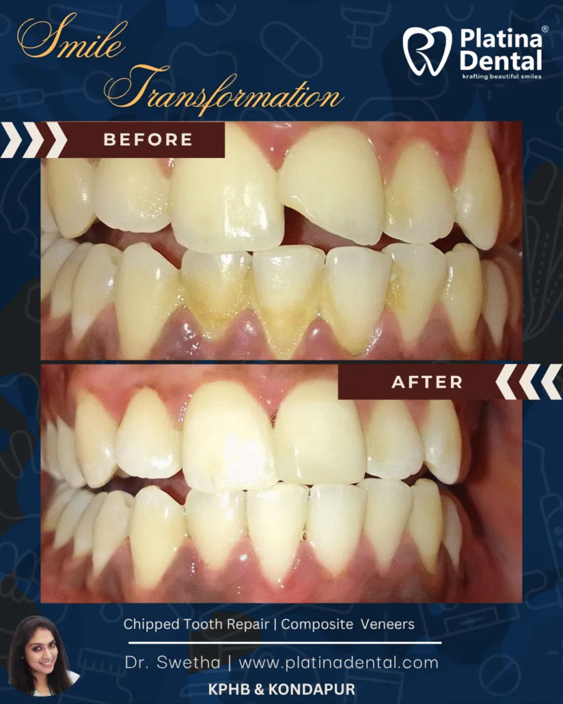 chipped broken front tooth repair in hyderabad